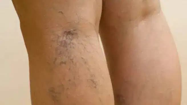 Babička mi prezradila, čo LIEČI kŕčové žily, opuchy a bolesť nôh lepšie, ako drahé prípravky: TU je recept!