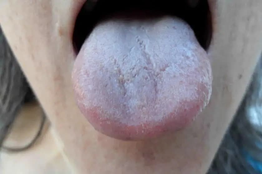 Pozrite sa na svoj JAZYK: Popraskané okraje alebo biely povlak? Môžete mať v tele máte túto chorobu!