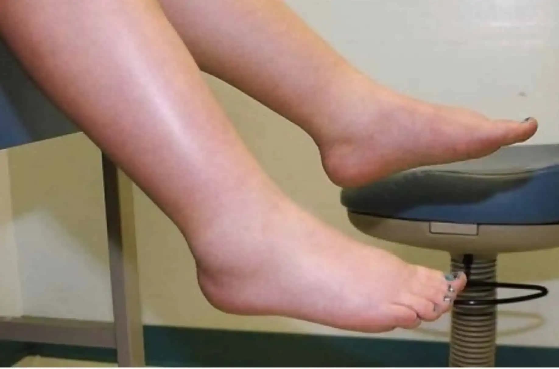 Ako odstrániť OPUCH nôh a zadržiavanú vodu? Tu je recept!