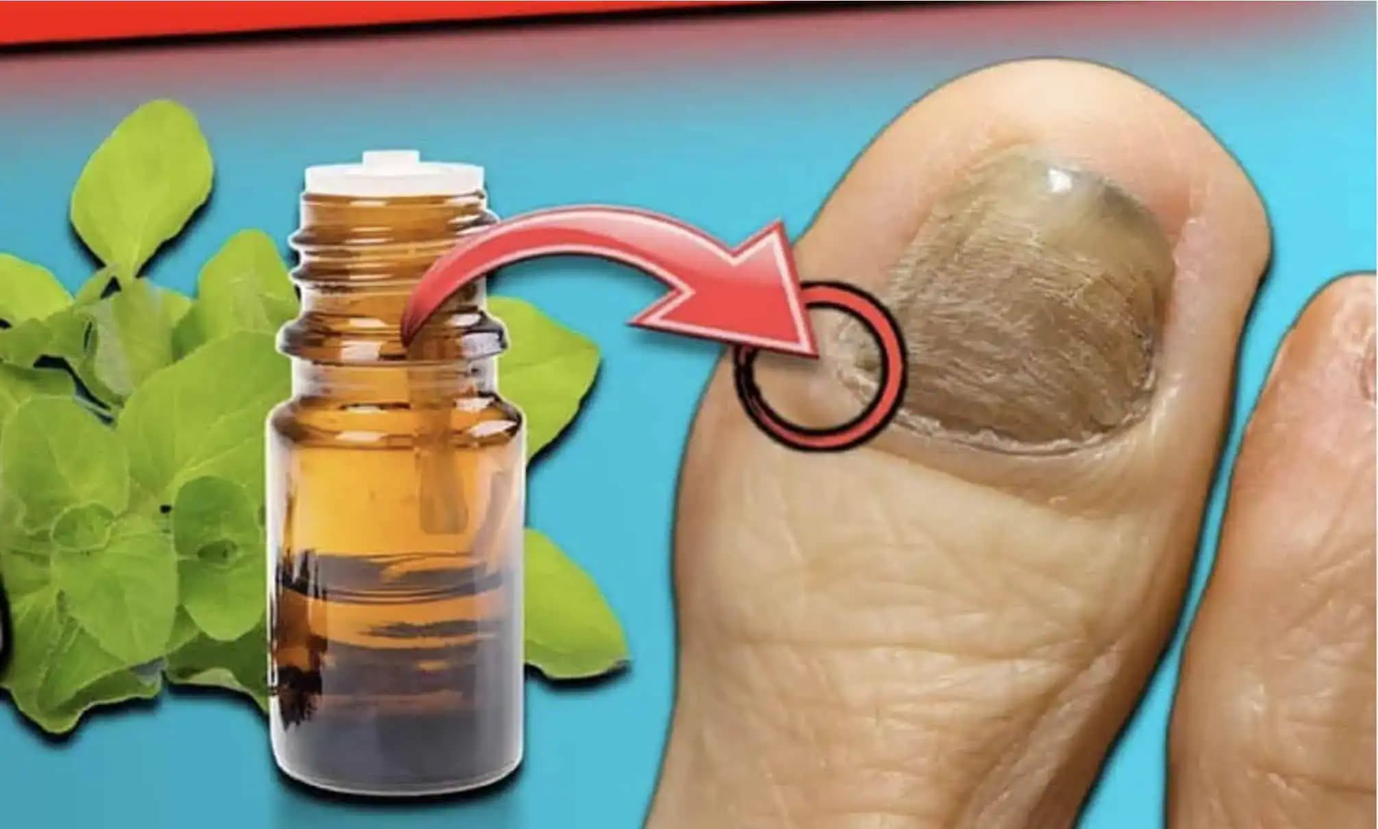 Zbavte sa PLESNE na nechtoch za 1 DEŇ! Toto je najsilnejšia prírodná zbraň proti plesni na nechtoch!