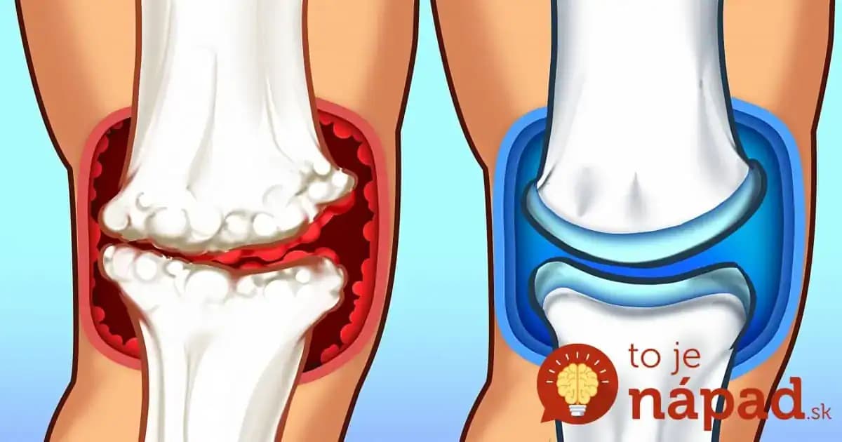 9 potravín, ktoré účinne liečia boľavé kĺby: Poraďte to každému, koho trápi bolesť a nič mu nezaberá!