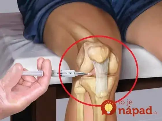 Toto povedzte každému, koho trápia kolená: Overené, odskúšané – stokrát lepšie, ako hltať prípravky proti bolesti!