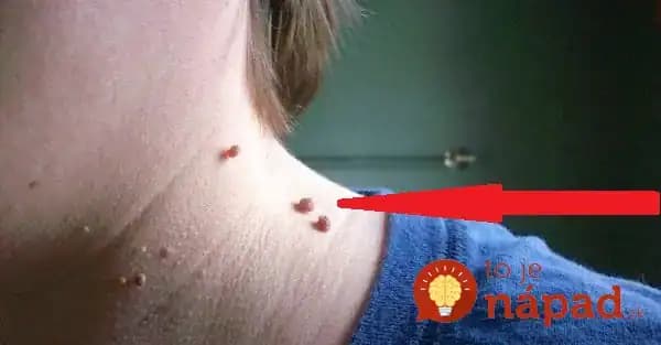 Máte na tele tieto kožné výrastky? Na ich odstránenie postačí 1 surovina!