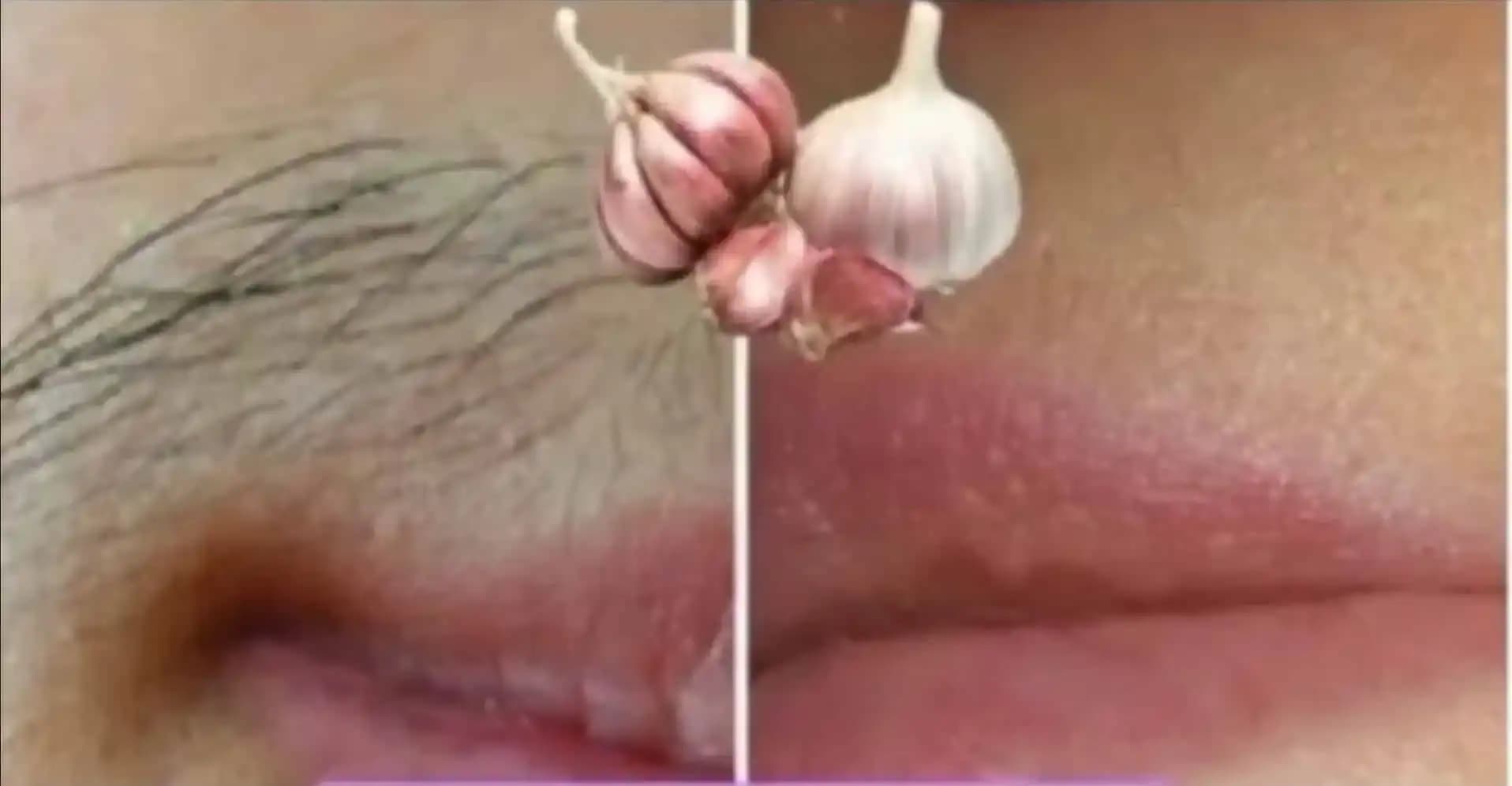 Návod, ako sa NATRVALO zbaviť nežiadúcich chĺpkov na tele, aj na tvári: Žiletky môžete rovno zahodiť!