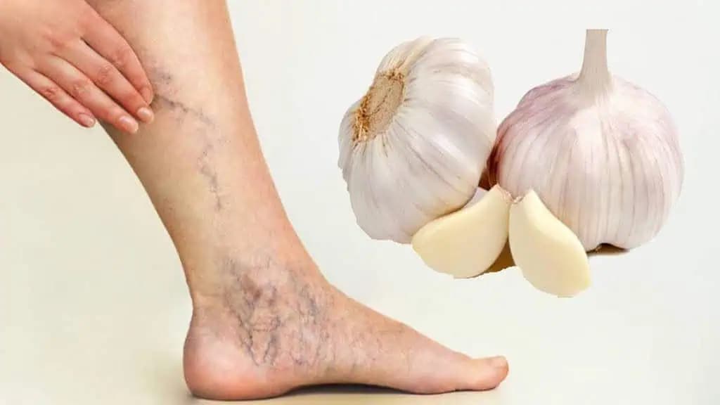 Trápia vás kŕčové žily, opuchy a bolesť nôh? Skúste tento domáci RECEPT, zmenu som cítila okamžite!