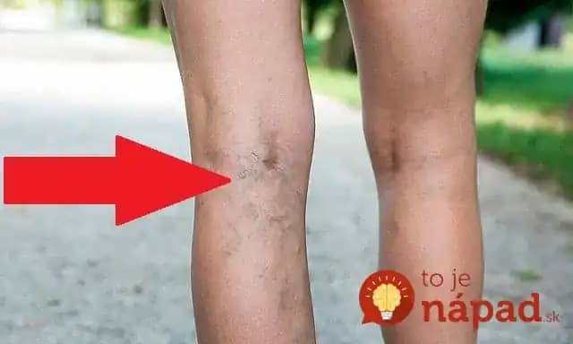 Ženy, ak sa u vás začnú objavovať kŕčové žily, urobte to čo najskôr: Toto na ne zaberá najlepšie a je to čistá príroda!