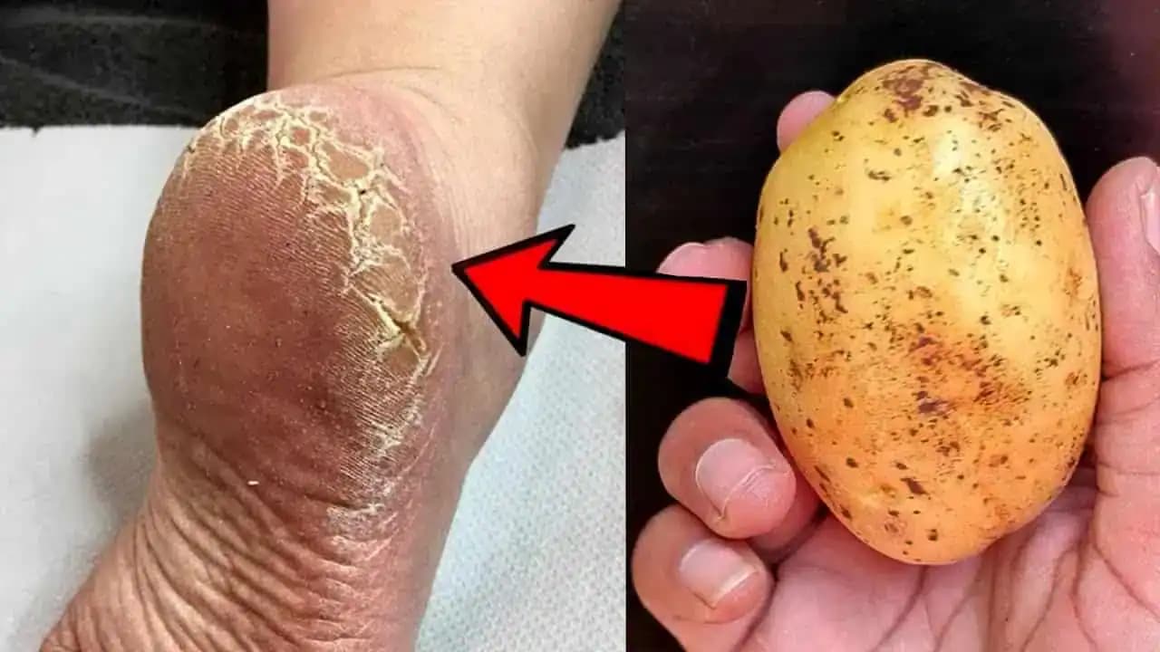 Kamarátka kozmetička mi poradila ZARUČENÝ trik na popraskané päty: Len 1 týždeň a budete mať kožu jemnú a zdravú!