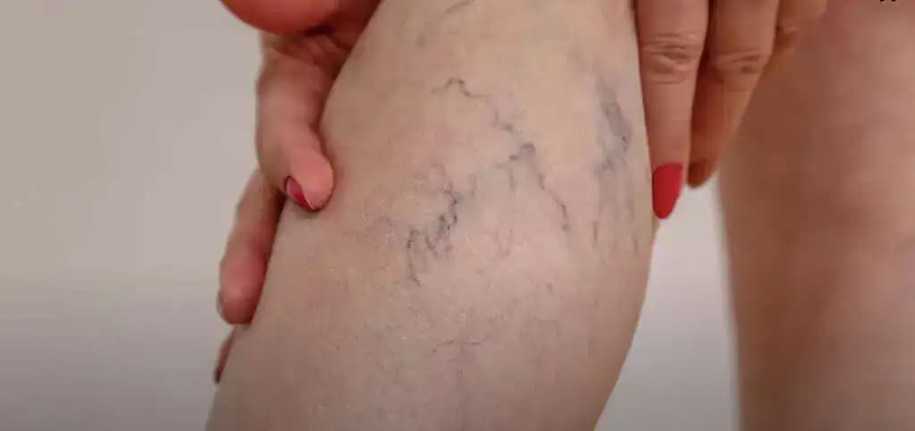Trápia vás boľavé nohy a zvlášť kŕčové žily? Musíte skúsiť, čo dokáže tento starý recept!