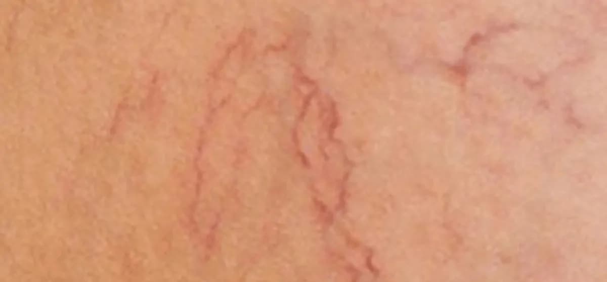 Bič na kŕčové a metličkové žily: Títo pomocníci vám zaručene pomôžu a nájdete ich doma v kuchyni!