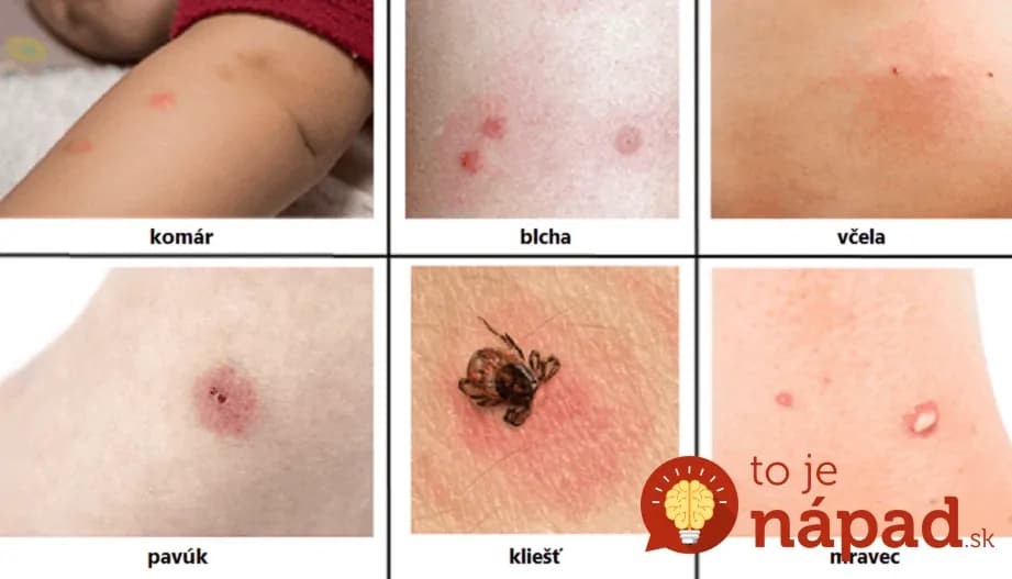 Väčšina ľudí si ich mýli a nevie ako zareagovať: Naučte sa rozoznať rôzne druhy uštipnutia a čo pomôže najrýchlejšie!