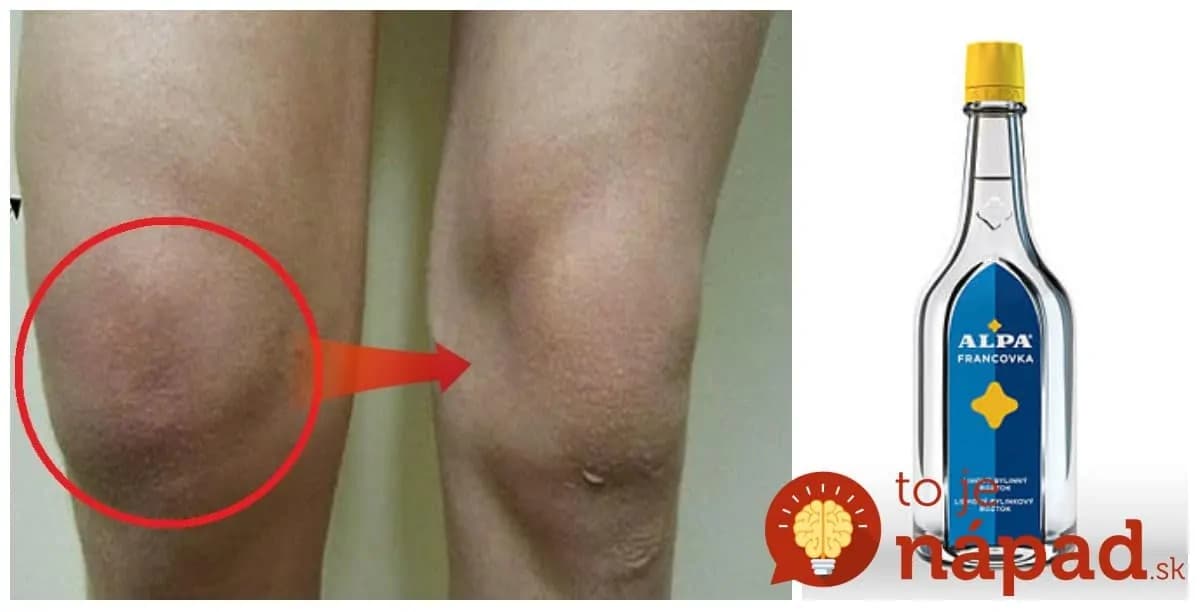 Zmiešajte alpu s touto prísadou a zabudnite, čo je reuma a bolesti kĺbov: Táto kombinácia funguje ako malý zázrak!