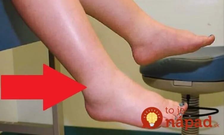 Ak sa u vás začnú objavovať opuchy a bolesť nôh, urobte to čo najskôr: Toto zaberá najlepšie a je to čistá príroda!