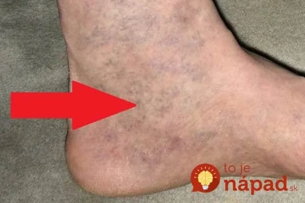 Je to naozaj sila: Stará rada našich babičiek, ako na kŕčové žily – toto spravte hneď, ako sa objavia!