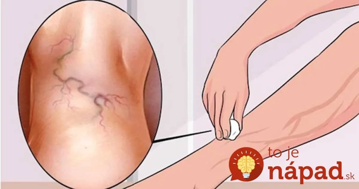 Zbohom kŕčové žily: Tento zázrak by vám poradila aj vaša prababka, schová do vrecka drahé mastičky z lekárne!