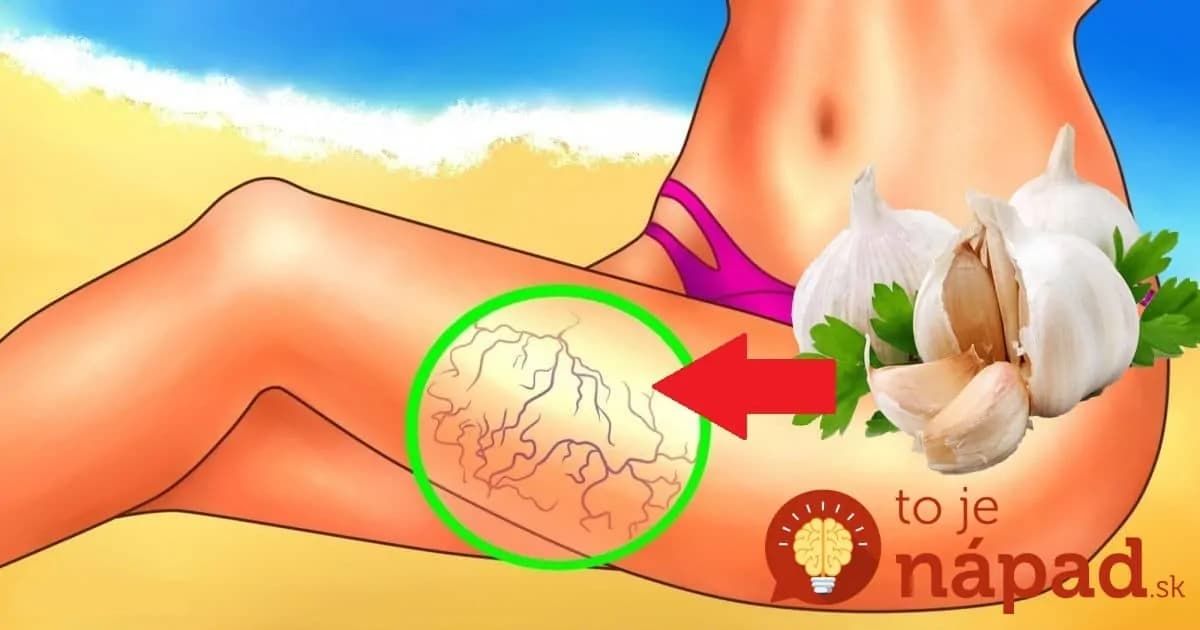 Keď skúsite, čo dokáže obyčajný cesnak s kŕčovými žilami, budete si ho všímať omnoho viac: Najlepšia rada, ako sa konečne zbaviť!
