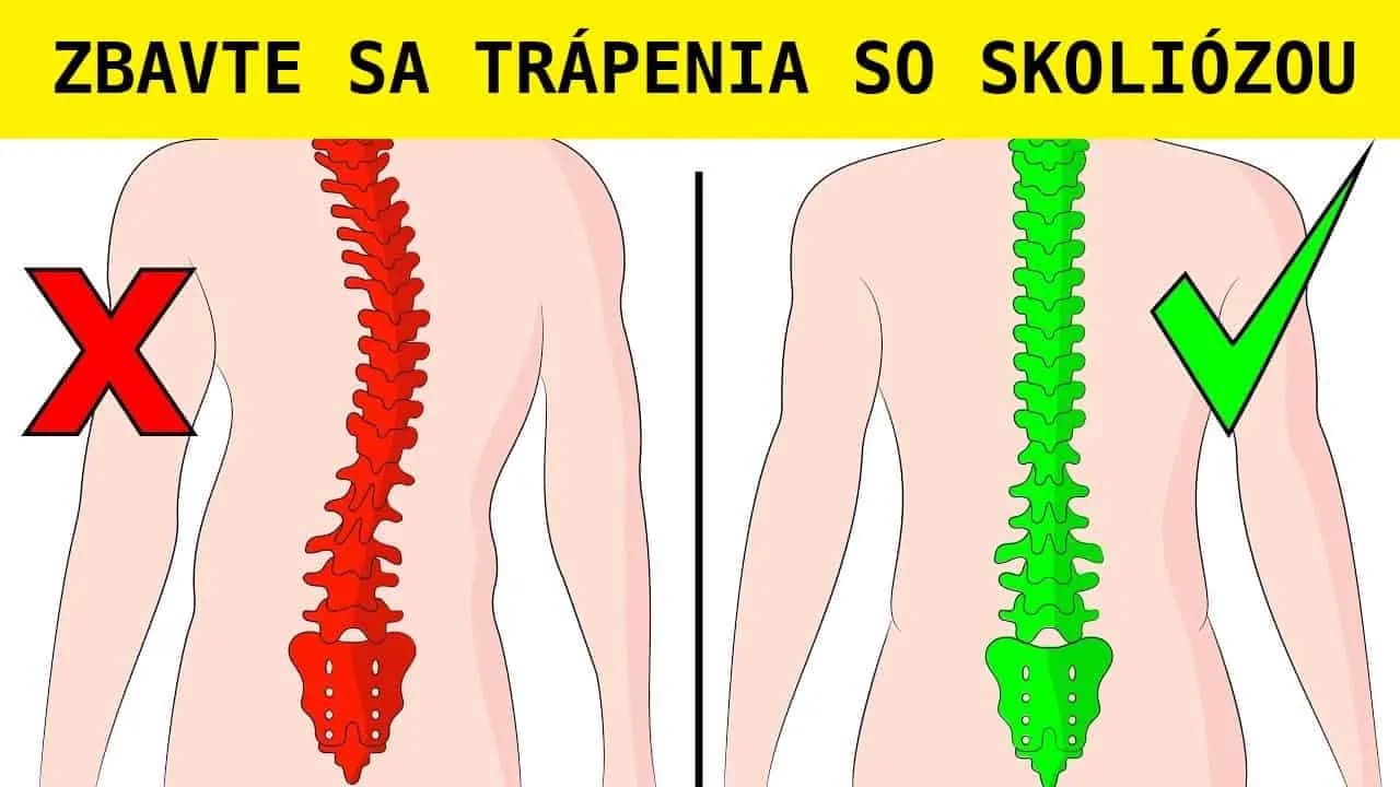 Stačia len 4 minúty denne a tieto cviky napravia aj skoliózu: Jednoduché cvičenie, ktoré už pomohlo mnohým ľuďom!