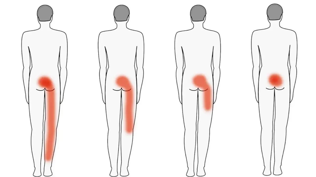 Chiropraktik ukázal cvičenie, ktoré natrvalo odstráni bolesť v dolnej časti chrbta!