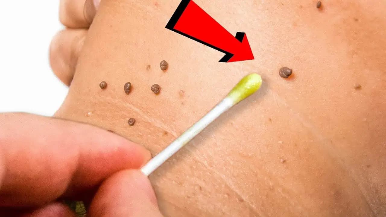 Tento OLEJ vymaže papilómy, bradavice a dokonca aj plesne – každá kvapka je na nezaplatenie!