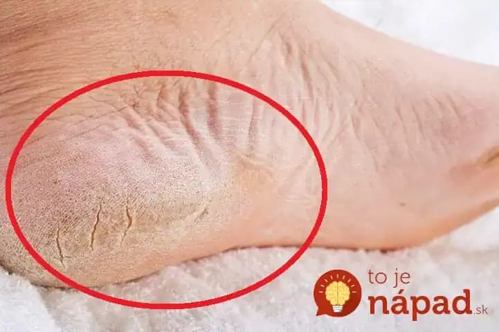 Máte popraskanú a suchú kožu na chodidlách? Vyskúšajte tento zvláštny trik, výsledok vás ohromí!