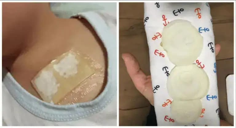 S.O.S. pri kašli a zápaloch priedušiek: Vysoko účinné domáce zábaly, ktoré dokážu rýchlo pomôcť aj v ťažkých prípadoch!