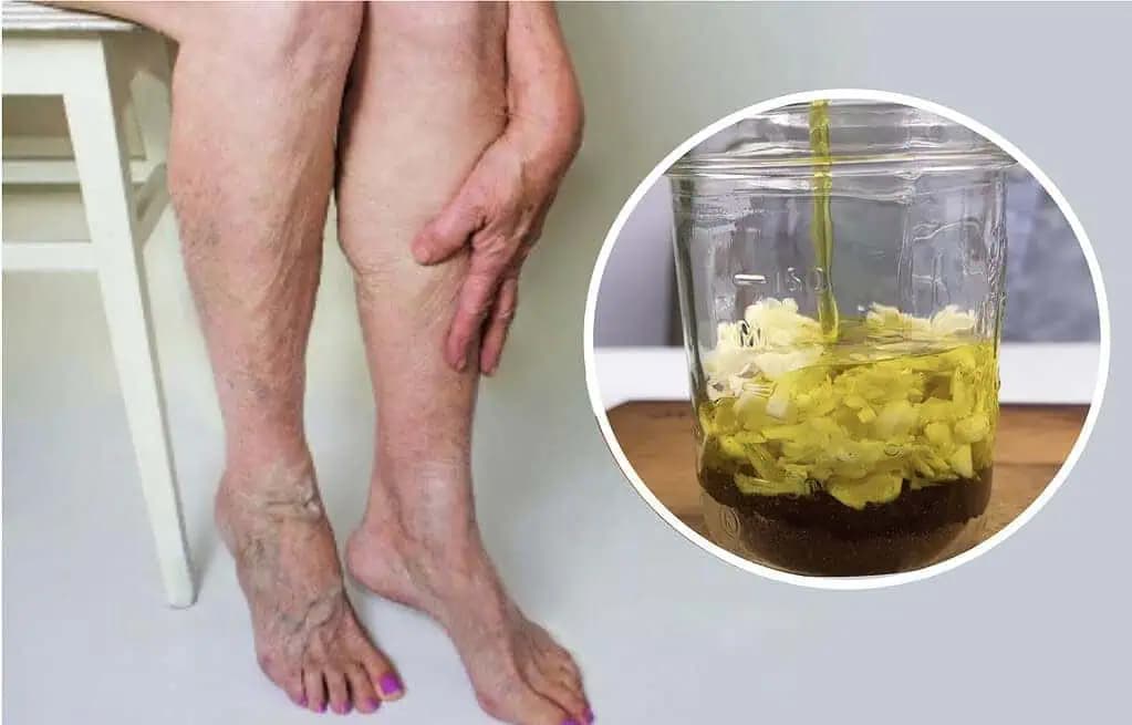 KLINČEKY A CESNAK: Recept, ktorý vám pomôže odstrániť kŕčové žily, bolesti kĺbov a kostí!